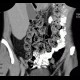Mesenteric lipomatosis in steroid treatment: CT - Computed tomography